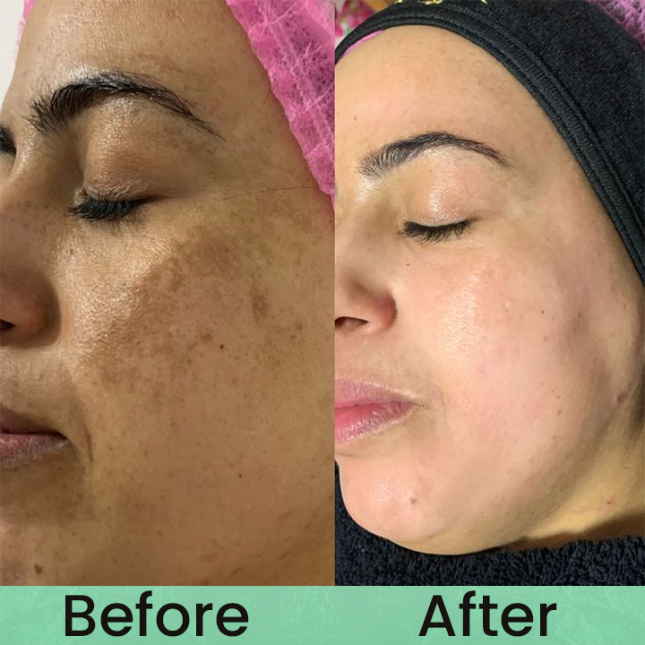 Made and Shipped from USA✨LIMETOW® Anti-freckle essence🌿