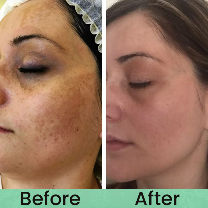 Made and Shipped from USA✨LIMETOW® Anti-freckle essence🌿