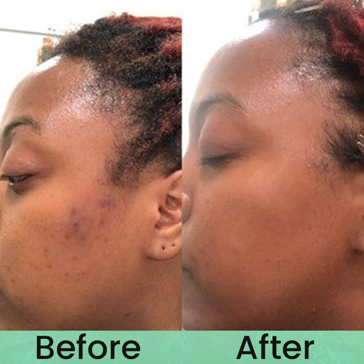Made and Shipped from USA✨LIMETOW® Anti-freckle essence🌿