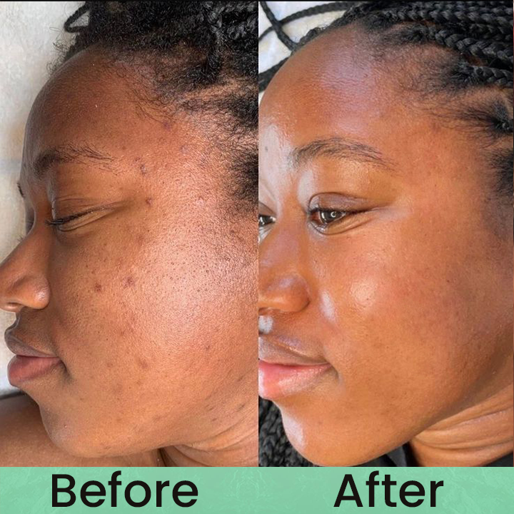 Made and Shipped from USA✨LIMETOW® Anti-freckle essence🌿