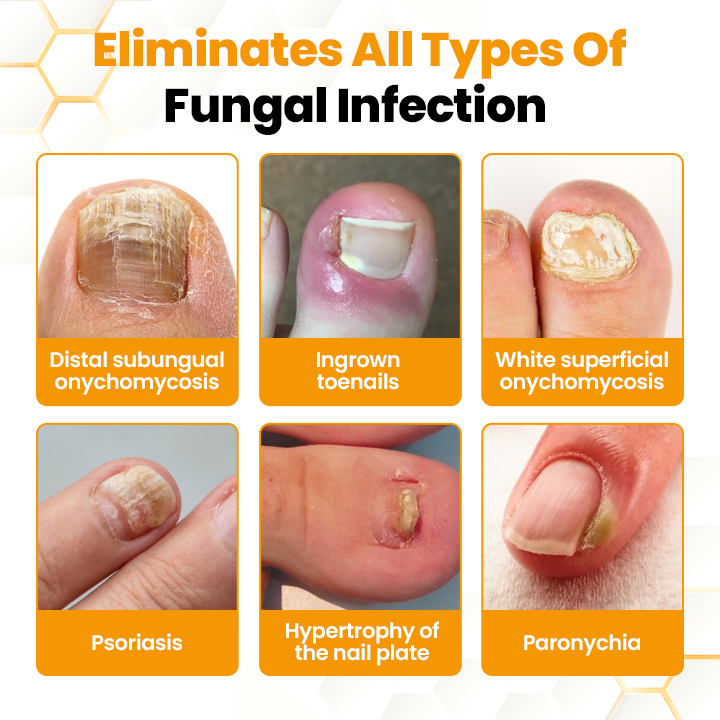 LIMETOW® BeeVenom Anti-Fungal Nail Renewal Oil
