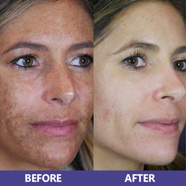 LIMETOW™ Niacinamide Brightening & Freckle Fade Essence