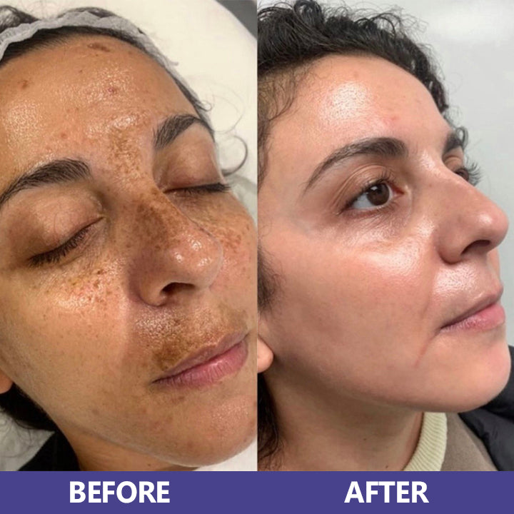 LIMETOW™ Niacinamide Brightening & Freckle Fade Essence