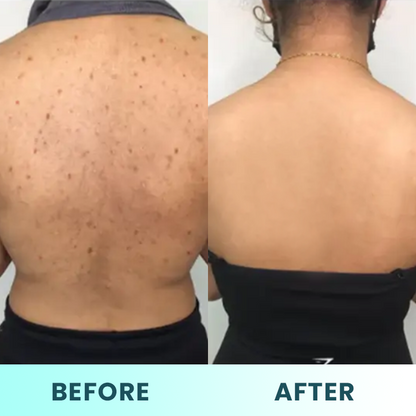 LIMETOW™ Back Acne Treatment Spray