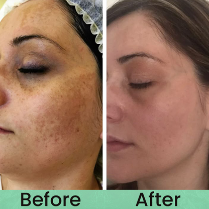 Made and Shipped from USA✨LIMETOW® Anti-freckle essence🌿