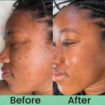 Made and Shipped from USA✨LIMETOW® Anti-freckle essence🌿