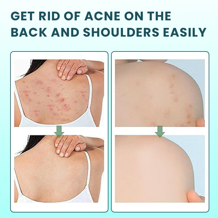 LIMETOW™ Back Acne Treatment Spray