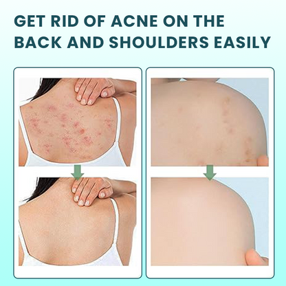 LIMETOW™ Back Acne Treatment Spray