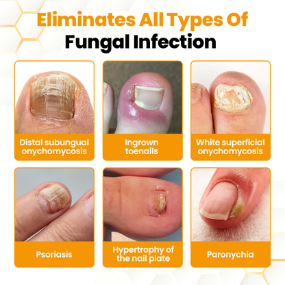 LIMETOW® BeeVenom Anti-Fungal Nail Renewal Oil