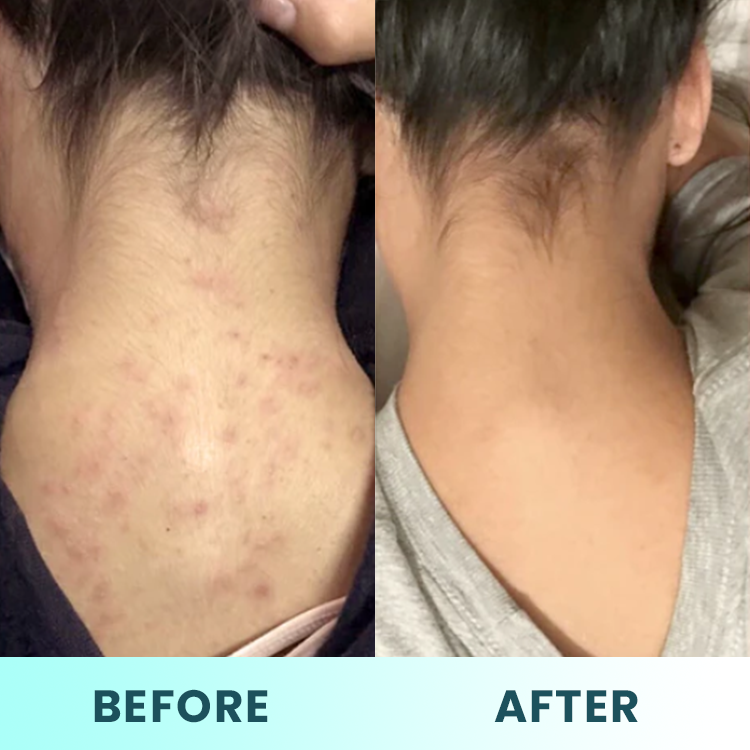 LIMETOW™ Back Acne Treatment Spray