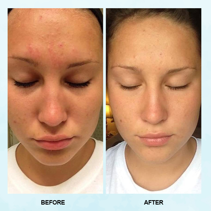 LIMETOW™ Blackhead Dissolving Gel