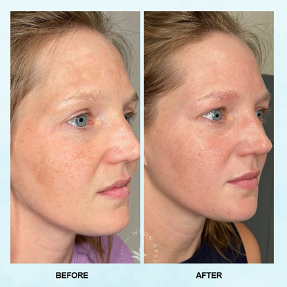 LIMETOW™ Blackhead Dissolving Gel