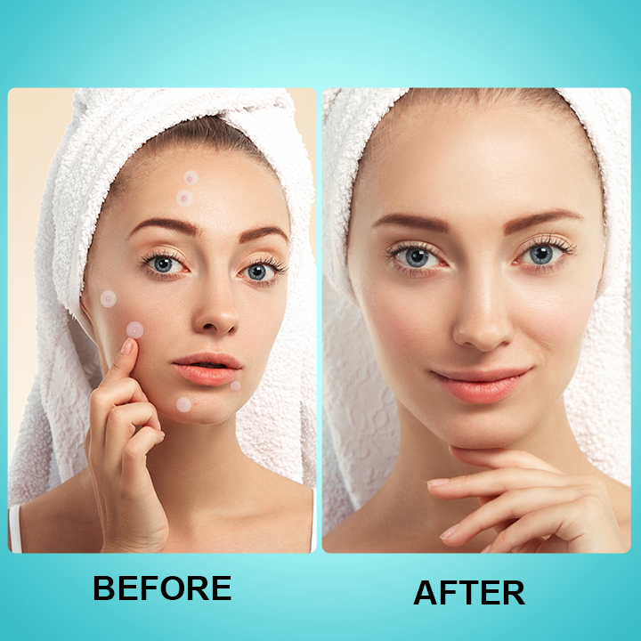 LIMETOW™ Microneedle Spot Clearing Patch