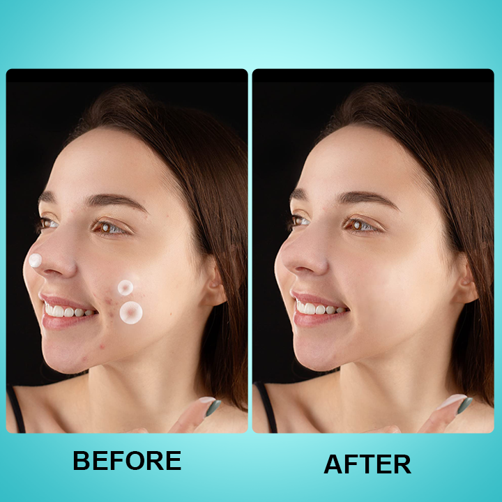 LIMETOW™ Microneedle Spot Clearing Patch