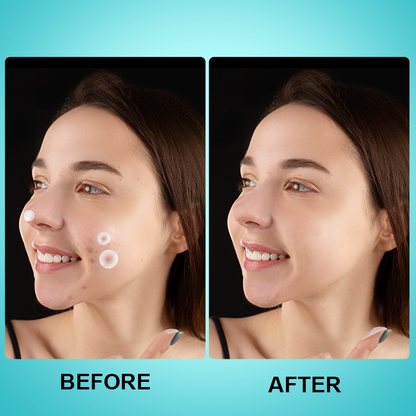 LIMETOW™ Microneedle Spot Clearing Patch